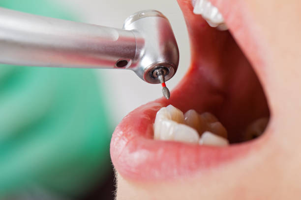 Best Emergency Tooth Extraction in Francisville, KY